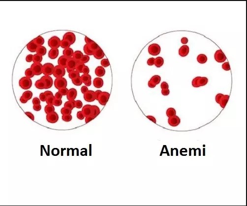 Anemi Türleri