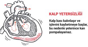 Kalp Yetmezliği Nedir